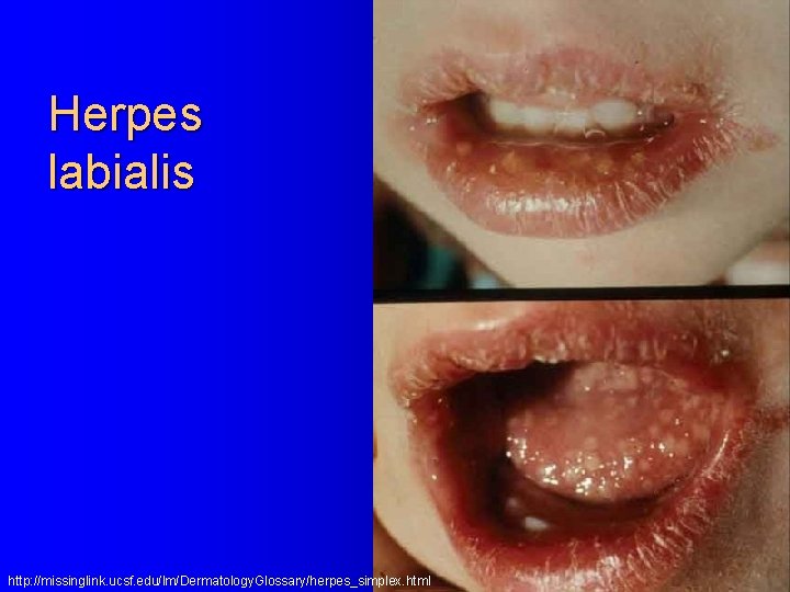 Herpes labialis http: //missinglink. ucsf. edu/lm/Dermatology. Glossary/herpes_simplex. html 