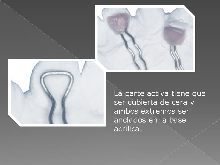 La parte activa tiene que ser cubierta de cera y ambos extremos ser anclados La parte activa tiene que ser cubierta de cera y ambos extremos ser anclados