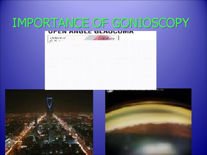 IMPORTANCE OF GONIOSCOPY 