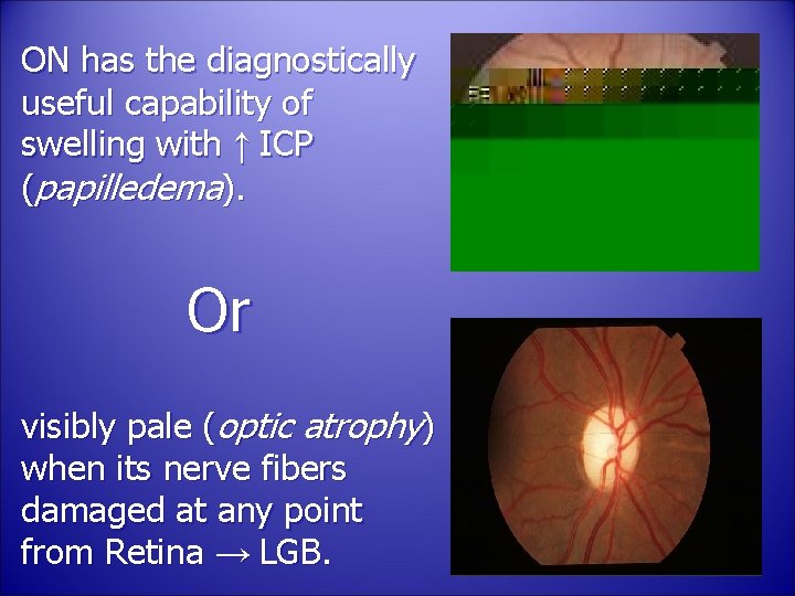 ON has the diagnostically useful capability of swelling with ↑ ICP (papilledema). Or visibly