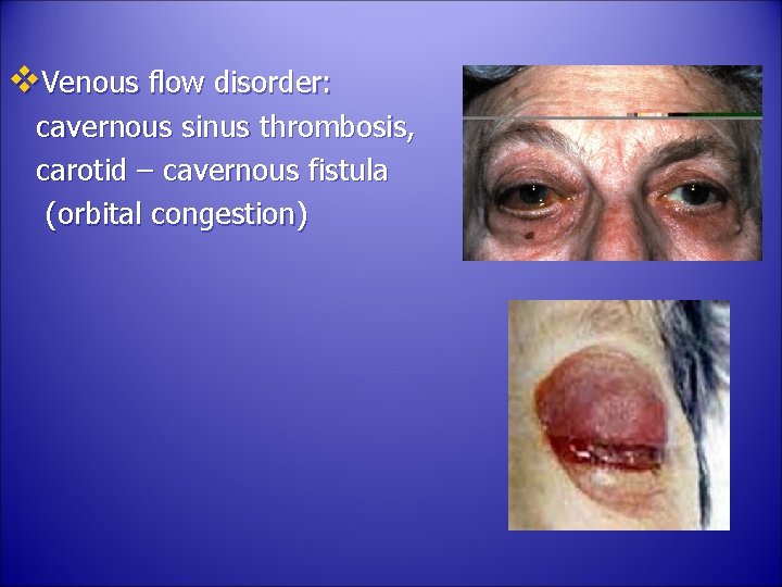 v. Venous flow disorder: cavernous sinus thrombosis, carotid – cavernous fistula (orbital congestion) 