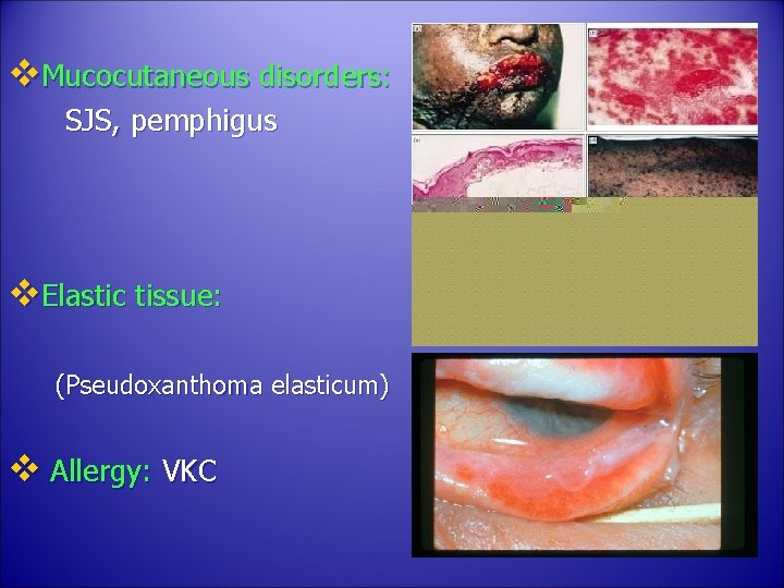 v. Mucocutaneous disorders: SJS, pemphigus v. Elastic tissue: (Pseudoxanthoma elasticum) v Allergy: VKC 