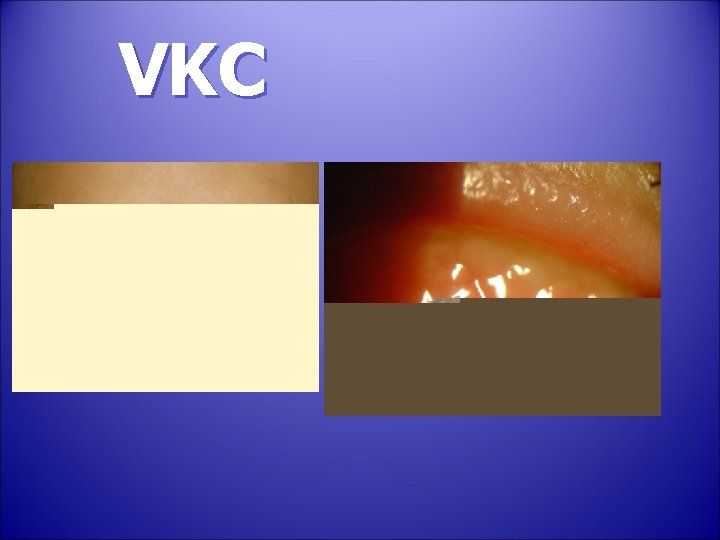 VKC 