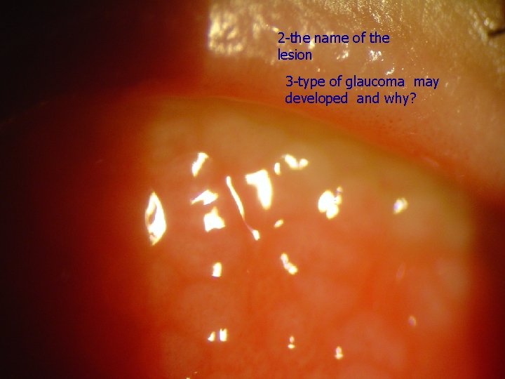 2 -the name of the lesion 3 -type of glaucoma may developed and why?