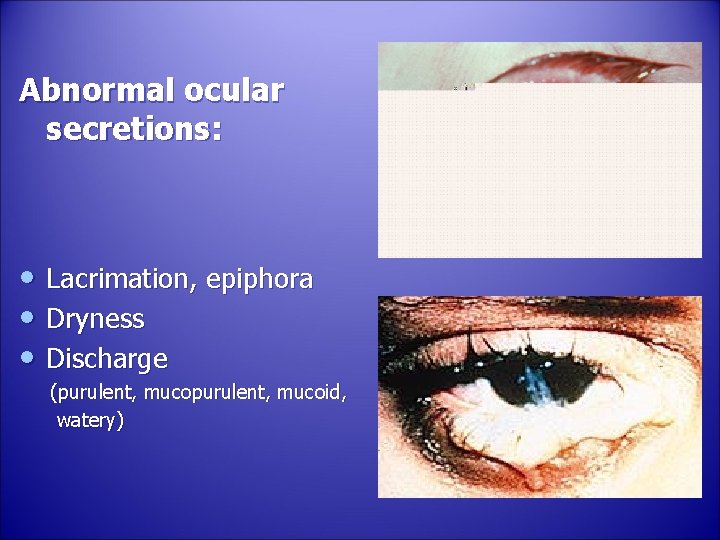 Abnormal ocular secretions: • Lacrimation, epiphora • Dryness • Discharge (purulent, mucoid, watery) 