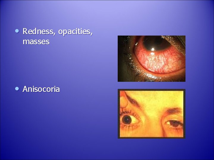  • Redness, opacities, masses • Anisocoria 