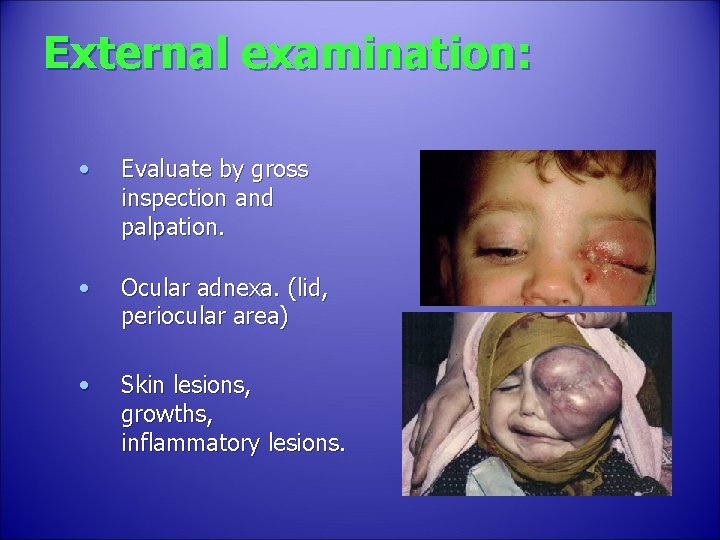 External examination: • Evaluate by gross inspection and palpation. • Ocular adnexa. (lid, periocular