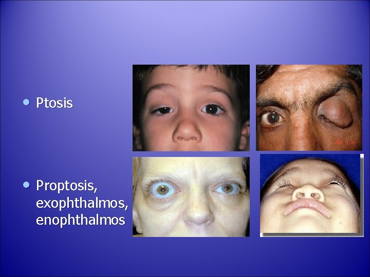  • Ptosis • Proptosis, exophthalmos, enophthalmos 