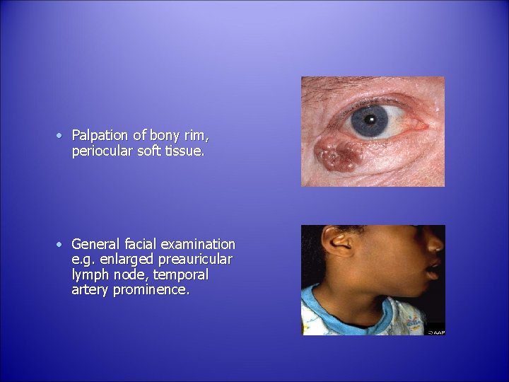  • Palpation of bony rim, periocular soft tissue. • General facial examination e.