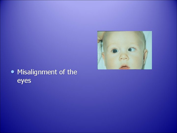  • Misalignment of the eyes 
