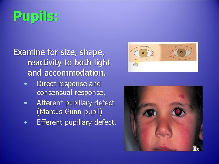 Pupils: Examine for size, shape, reactivity to both light and accommodation. • • •