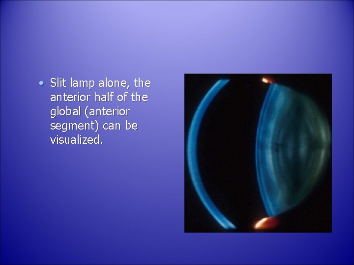  • Slit lamp alone, the anterior half of the global (anterior segment) can