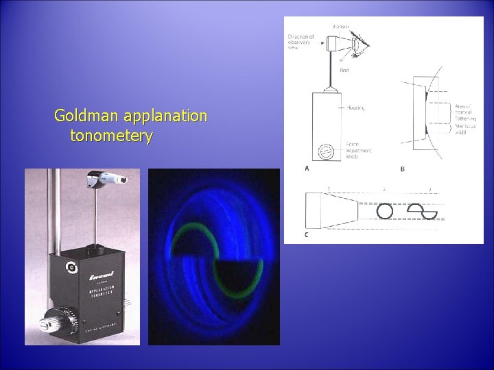 Goldman applanation tonometery 