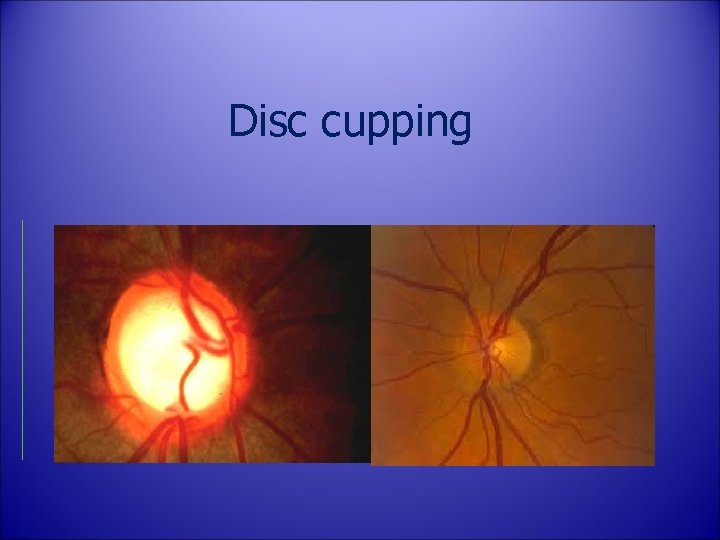 Disc cupping 
