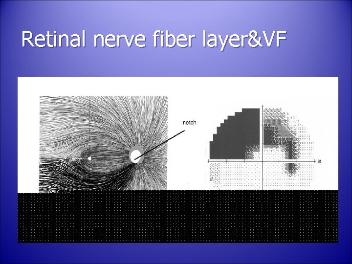 Retinal nerve fiber layer&VF 