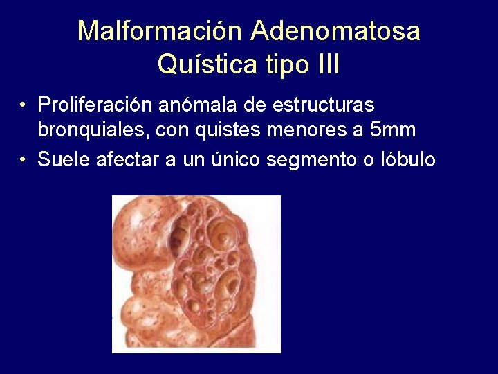 Malformación Adenomatosa Quística tipo III • Proliferación anómala de estructuras bronquiales, con quistes menores