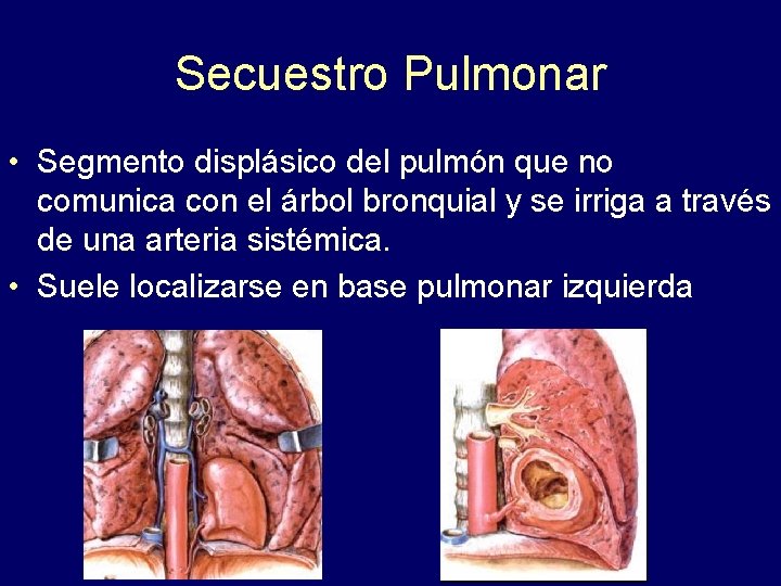 Secuestro Pulmonar • Segmento displásico del pulmón que no comunica con el árbol bronquial