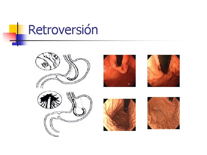 Retroversión 