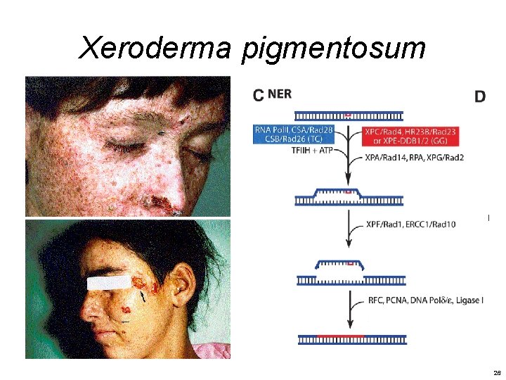 Xeroderma pigmentosum 26 