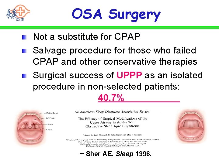 OSA Surgery Not a substitute for CPAP Salvage procedure for those who failed CPAP