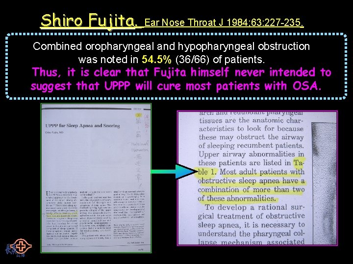 Shiro Fujita. Ear Nose Throat J 1984; 63: 227 -235. Combined oropharyngeal and hypopharyngeal