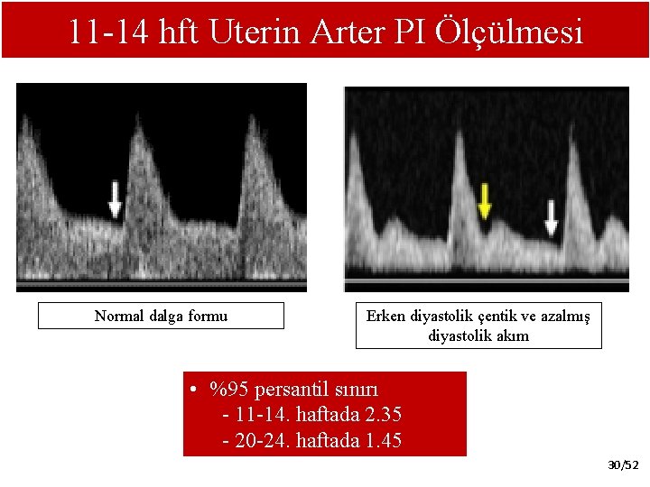 11 -14 hft Uterin Arter PI Ölçülmesi Normal dalga formu Erken diyastolik çentik ve