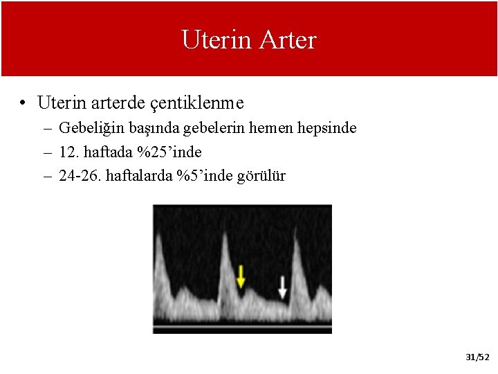 Uterin Arter • Uterin arterde çentiklenme – Gebeliğin başında gebelerin hemen hepsinde – 12.