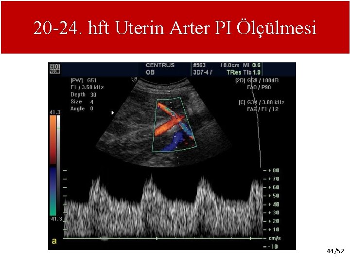 20 -24. hft Uterin Arter PI Ölçülmesi 44/52 