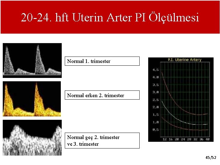 20 -24. hft Uterin Arter PI Ölçülmesi Normal 1. trimester Normal erken 2. trimester