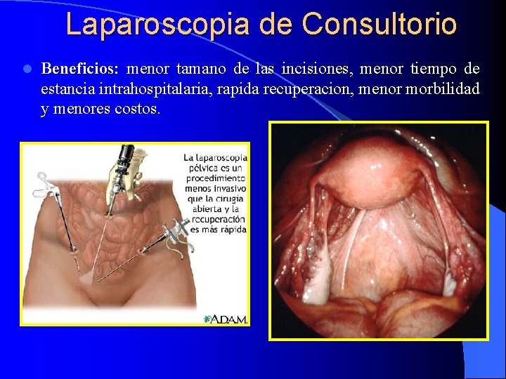 Laparoscopia de Consultorio l Beneficios: menor tamano de las incisiones, menor tiempo de estancia