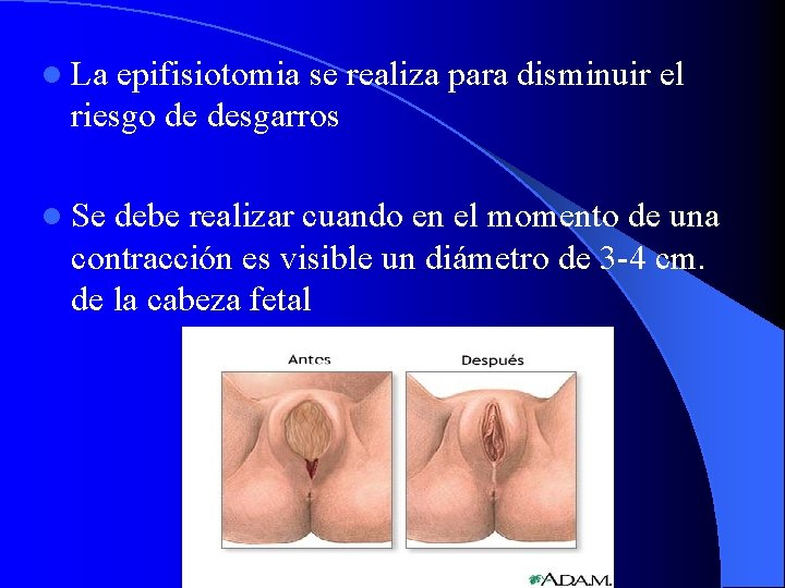 l La epifisiotomia se realiza para disminuir el riesgo de desgarros l Se debe