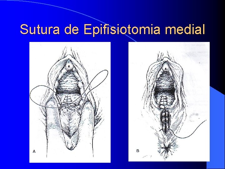 Sutura de Epifisiotomia medial 