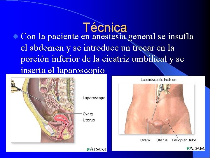 l Con Técnica la paciente en anestesia general se insufla el abdomen y se