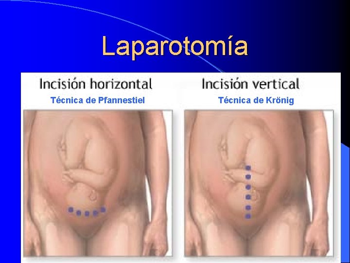 Laparotomía Técnica de Pfannestiel Técnica de Krönig 