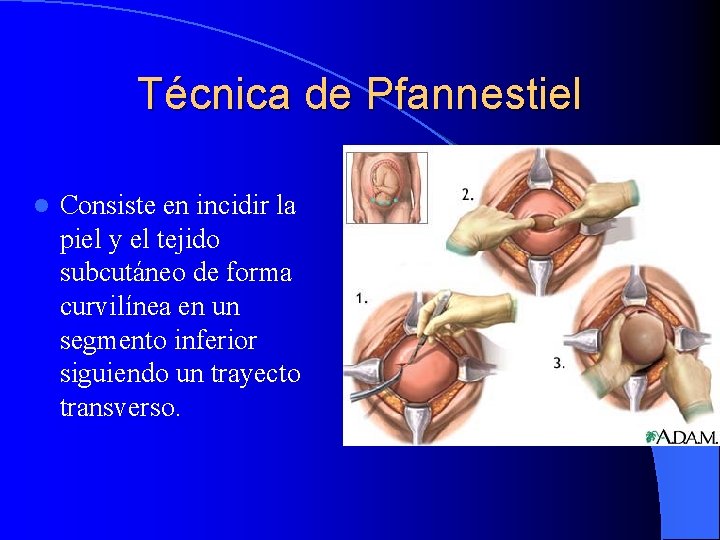 Técnica de Pfannestiel l Consiste en incidir la piel y el tejido subcutáneo de