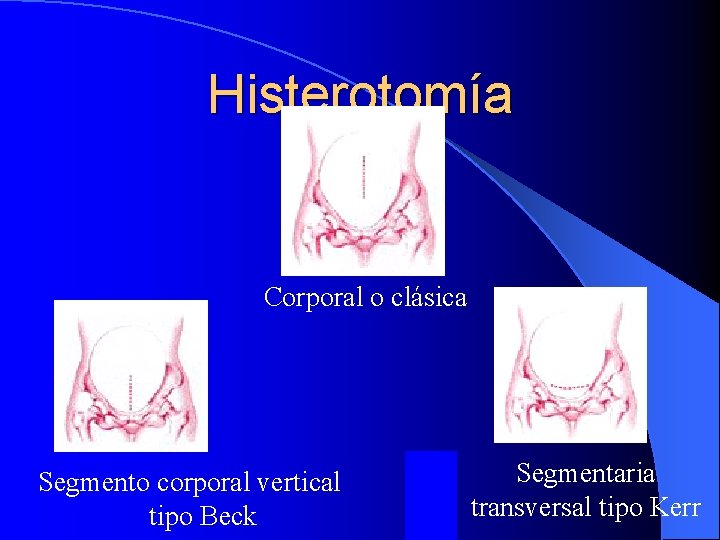 Histerotomía Corporal o clásica Segmento corporal vertical tipo Beck Segmentaria transversal tipo Kerr 