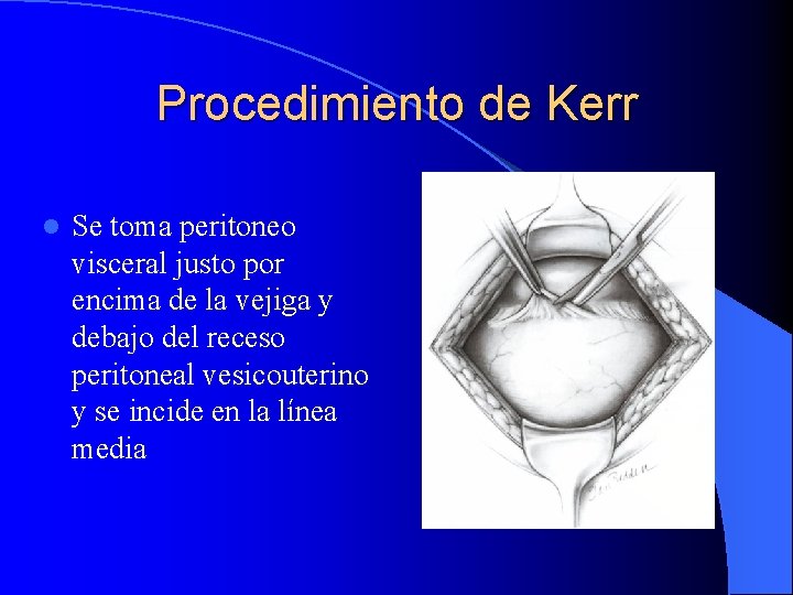 Procedimiento de Kerr l Se toma peritoneo visceral justo por encima de la vejiga