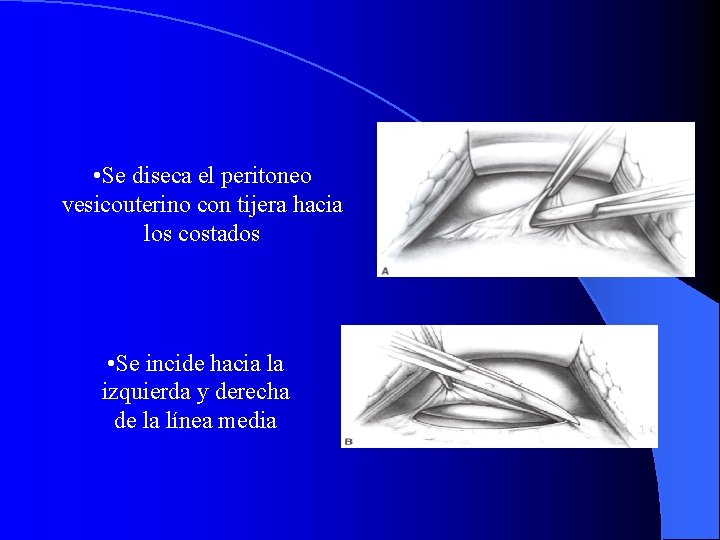  • Se diseca el peritoneo vesicouterino con tijera hacia los costados • Se