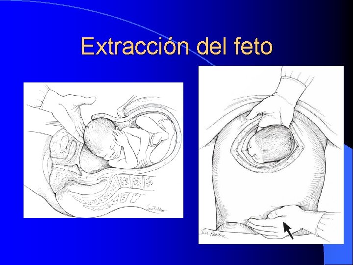 Extracción del feto 