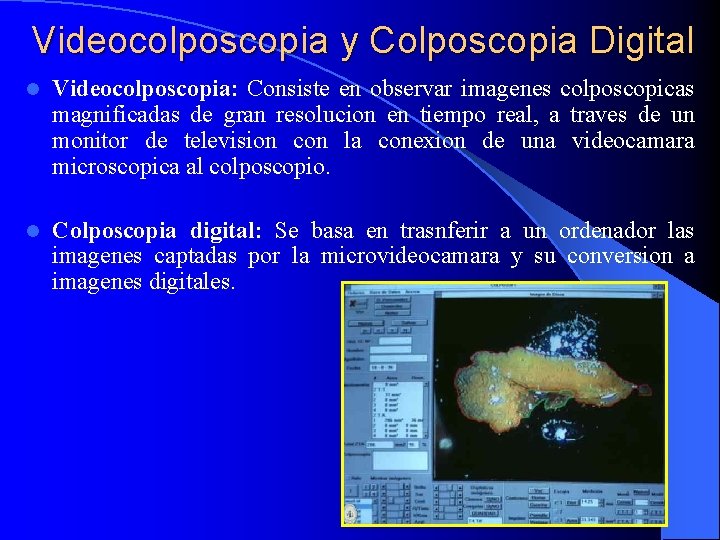 Videocolposcopia y Colposcopia Digital l Videocolposcopia: Consiste en observar imagenes colposcopicas magnificadas de gran