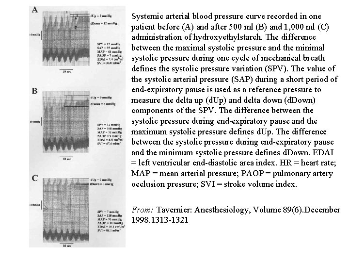 Systemic arterial blood pressure curve recorded in one patient before (A) and after 500