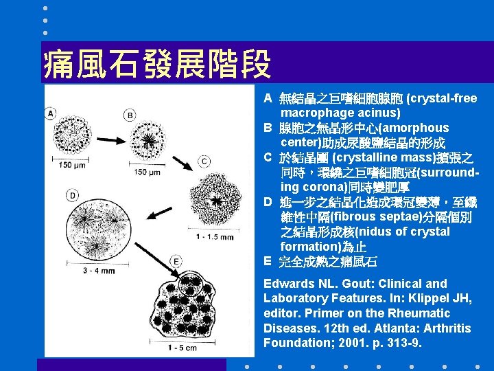 痛風石發展階段 A 無結晶之巨嗜細胞腺胞 (crystal-free macrophage acinus) B 腺胞之無晶形中心(amorphous center)助成尿酸鹽結晶的形成 C 於結晶團 (crystalline mass)擴張之 同時，環繞之巨嗜細胞冠(surrounding