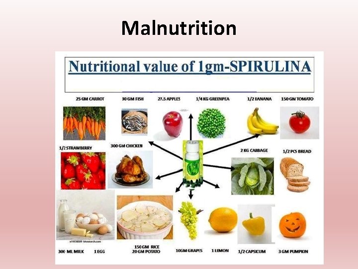 Malnutrition Malnutrition