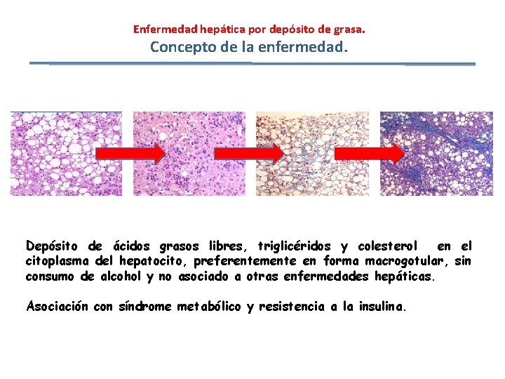 Enfermedad hepática por depósito de grasa. Concepto de la enfermedad. Depósito de ácidos grasos