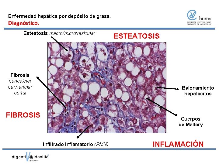 Enfermedad hepática por depósito de grasa. Diagnóstico. Esteatosis macro/microvesicular Fibrosis pericelular perivenular portal ESTEATOSIS