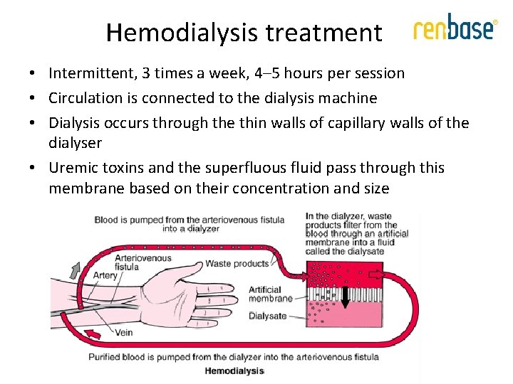 Hemodialysis treatment • Intermittent, 3 times a week, 4– 5 hours per session • Hemodialysis treatment • Intermittent, 3 times a week, 4– 5 hours per session •