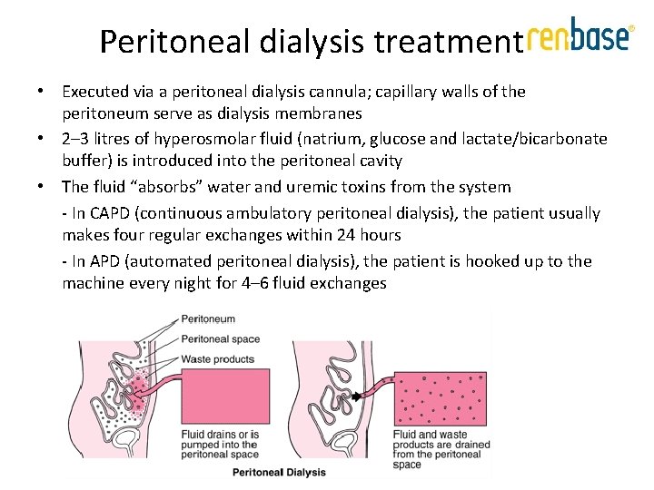 Peritoneal dialysis treatment • Executed via a peritoneal dialysis cannula; capillary walls of the Peritoneal dialysis treatment • Executed via a peritoneal dialysis cannula; capillary walls of the