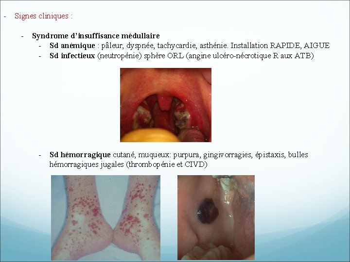 - Signes cliniques : - Syndrome d’insuffisance médullaire - Sd anémique : pâleur, dyspnée, - Signes cliniques : - Syndrome d’insuffisance médullaire - Sd anémique : pâleur, dyspnée,