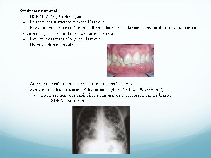 - Syndrome tumoral : - HSMG, ADP périphériques - Leucémides = atteinte cutanée blastique - Syndrome tumoral : - HSMG, ADP périphériques - Leucémides = atteinte cutanée blastique