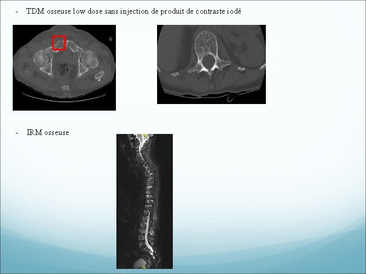 - TDM osseuse low dose sans injection de produit de contraste iodé - IRM - TDM osseuse low dose sans injection de produit de contraste iodé - IRM